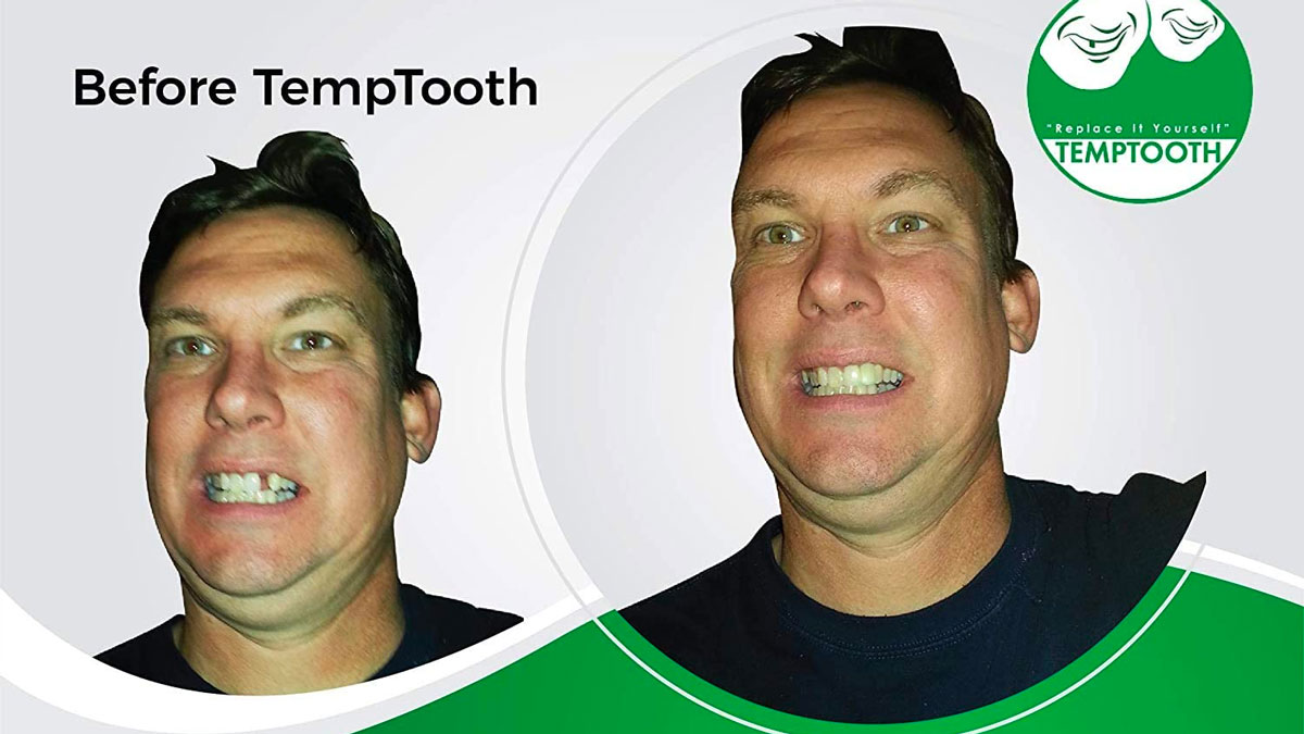 TempTooth Kit DIY Tooth Replacement